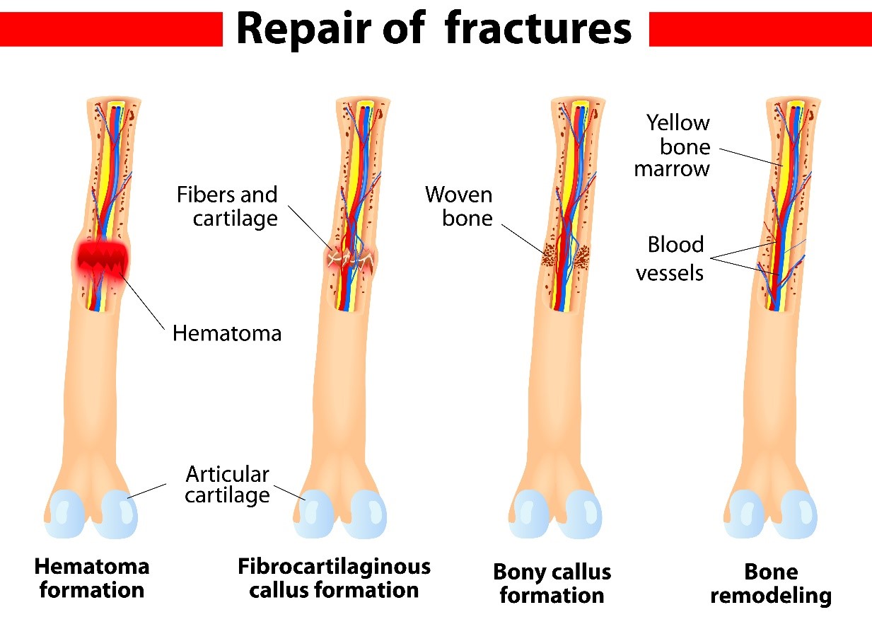 Repair of fractures